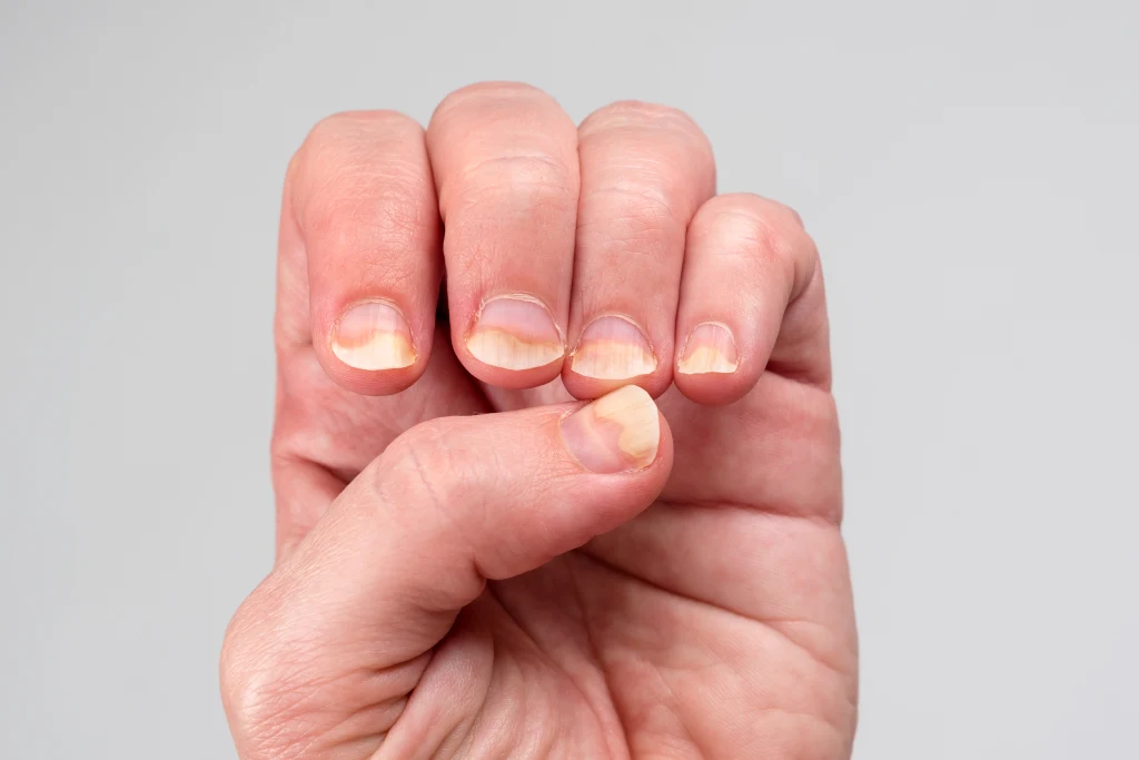 nail diseases and disorders